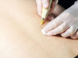 Lee más sobre el artículo Qué es y para qué sirve la carboxiterapia, Respondemos todas las preguntas
