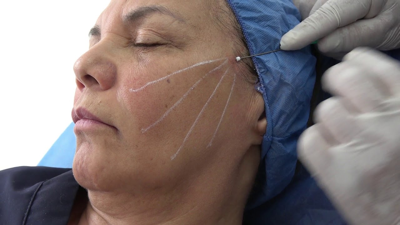 Lee más sobre el artículo Hilos tensores en el rostro, conoce sus ventajas y desventajas